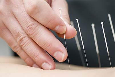 acupuncture for chronic pain